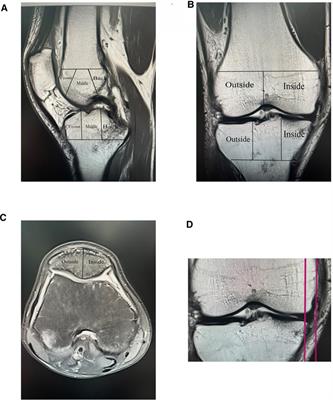 A nomogram based on radiological features of MRI for predicting the risk of severe pain in patients with osteoarthritis of the knee